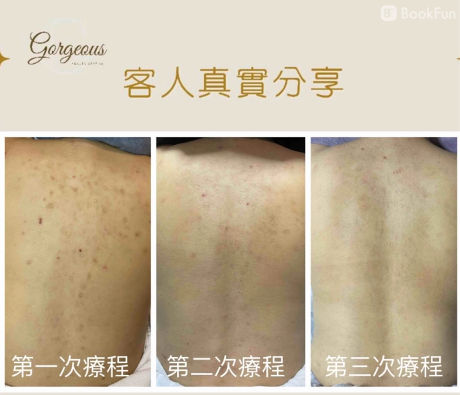 優質 九龍 美容 - 夏日背部祛印淨白活肌療程 - Gorgeous Beauty Centre Limited | BookFun