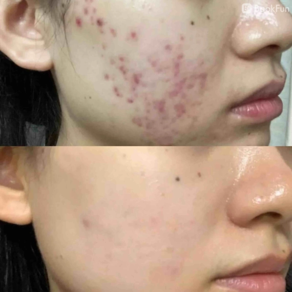 優質 九龍 美容 - 男士陶瓷肌暗瘡護理 - Apple Beauty Origin | BookFun