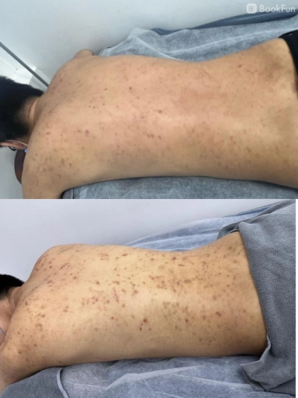 quality 陶瓷肌 身體（改善暗瘡，暗瘡印、毛囊堵塞） - Apple Beauty Origin - 美容 in 九龍 | BookFun